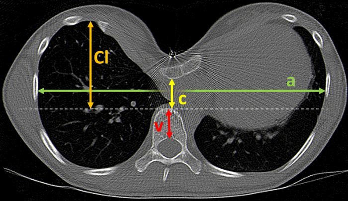 Pectus Excavatum Ct 